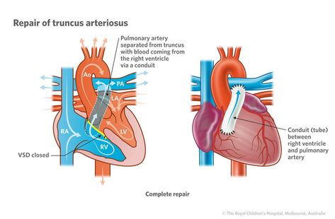 April | 2016 | PAINE Podcast and Medical Blog Chd Mom, Cleft Lip And Palate, Heart Warrior, Reducing Blood Pressure, Money For Nothing, Congenital Heart Defect, Heart Defect, Healthy Blood Pressure, Cardiology