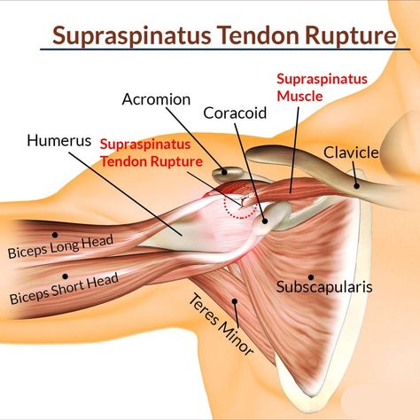 🚨Supraspinatus Tendon Rupture: 📌Key Anatomy and Clinical Impact The supraspinatus tendon, part of the rotator cuff in the shoulder, is crucial for arm abduction and shoulder stability. A rupture can occur due to acute trauma or chronic wear, leading to significant shoulder dysfunction. 🦴Anatomy Overview: Supraspinatus Muscle and Tendon:Located on the top of the scapula, this muscle attaches to the humerus via the supraspinatus tendon, which passes under the acromion. 🍖Acromion and Clavi... Supraspinatus Muscle, Shoulder Anatomy, Shoulder Surgery, Human Body Anatomy, Muscle Anatomy, Medical Anatomy, Rotator Cuff, Body Anatomy, Anatomy And Physiology