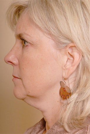 Neck Lift Before & After Pictures - RealSelf Natural Neck Lift, Chin Lift Before And After, Double Chin Before And After, Neck Lipo Before And After, Face Lift Before And After, Neck Lift Before And After, Lower Face Lift Before And After, Chin Lipo Before And After, Mini Face Lift Before And After