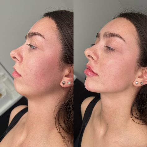 Chin, Lip & Jawline Filler. ✨💉 Double Chin Fillers Before And After, Jaw Surgery Aesthetic, Before And After Jaw Filler, Cheek And Chin Fillers Before After, Pixie Tip Lift Nose Filler, Profile Balancing Fillers, Chin And Jawline Fillers, Face Fillers Before And After Cheeks, Facial Balancing Filler Before And After