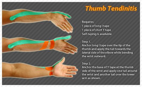 K Tape, Kinesio Tape, Kt Tape, Kinesio Taping, Wrist Pain, Psoas Muscle, Kinesiology Taping, Hand Pain, Hand Therapy