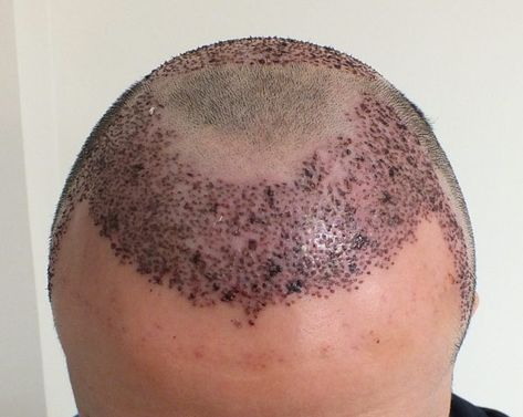 Hair Transplant Cost, Hair Transplant Procedure, Androgenetic Alopecia, Fue Hair Transplant, Best Hair Transplant, Hair Therapy, Regrow Hair, Hair Breakage, Hair Regrowth