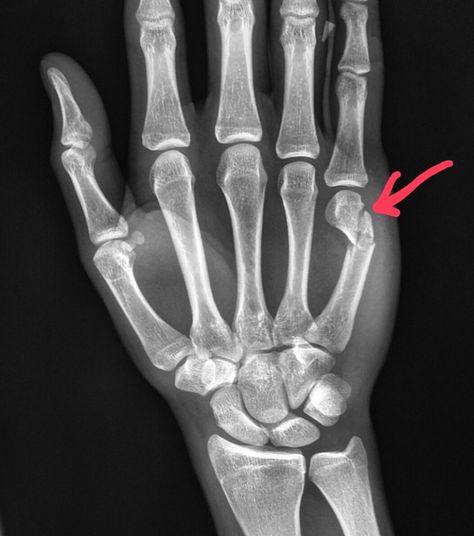 #Hand #Xray shows a #boxer's #fracture after a #patient was in a #fight. #radiologist #radiology #trauma #pain #injury Hand Fracture Snap, Indian Money Wallpaper Backgrounds, Hand Xray, Bff Backgrounds For 2 Aesthetic, Fracture Photo, Hand Fracture, Medical Drawings, Beach Vacation Pictures, Attitude Bio For Instagram