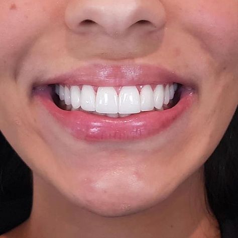 Porcelain veneers can change a smile dramatically and . give you a huge confidence boost Porcelain Veneers, Dental Laboratory, Perfect Teeth, Dental Veneers, Dental Art, Confidence Boost, Super Natural, Dental Clinic, Beautiful Smile