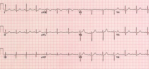 Normal ECG-- queen ECK practice Cath Lab Nursing, Normal Ecg, 9th Grade Math, Laboratory Design, Studying Medicine, Medical Notes, Normal Heart, Lab Values, Queen's University