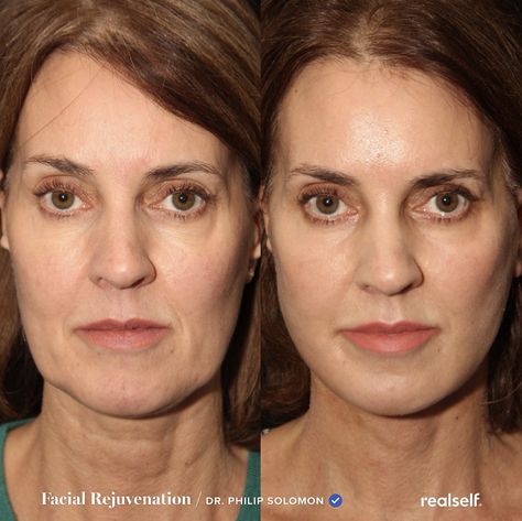 Sagging Skin Face, Facelift Recovery, Mid Face Lift, Lower Face Lift, Facelift Before And After, Facelift Surgery, Face Procedures, Facelift Procedure, Laser Peel