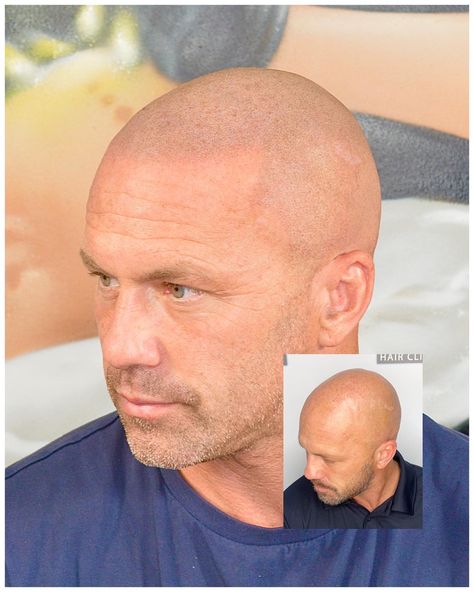 Image of a scalp micropigmentation result Hair Tattoo Men, Hairline Tattoos, Bald Men Style, Scalp Micropigmentation, Hair Tattoo, Shave My Head, Hair Clinic, Beefy Men, Bald Women