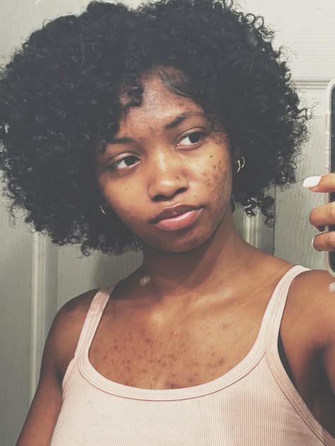 Acne Black Women, Acne Women, Girl With Acne, Black Teenage Girl, Melanin Skin, Big Nose Beauty, Quick Natural Hair Styles, Bare Beauty, Braids Hairstyles Pictures