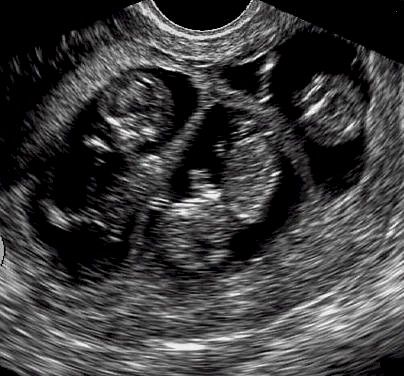 Ultrasound image of triplets at approximately 11 weeks of gestation. Twins Ultrasound Aesthetic, Triplets Ultrasound, Triplet Aesthetic, Sonographer Aesthetic, Ultrasound Aesthetic, Triplets Aesthetic, Triplets Pregnancy, Multiple Births, Baby Ultrasound