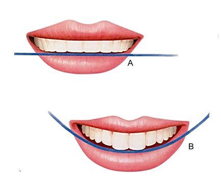 Teeth Correction, Dental Bleaching, Teeth Aesthetic, Pretty Teeth, Dental Aesthetics, Dental Photography, Veneers Teeth, Dental Fun, Aesthetic Dentistry