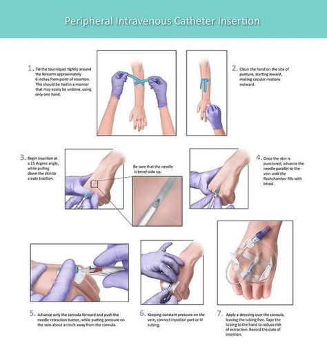 Peripheral Intravenous Catheter Insertion #nursingschool #nursingstudent #study - Image Credits: Pixels Catheter Insertion, Nursing School Inspiration, Nurse Teaching, Nursing School Motivation, Basic Anatomy And Physiology, Nurse Study Notes, Nursing Student Tips, Nursing School Humor, Medical Student Study