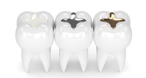 Amalgam (mixed metal) fillings can be dangerous to your health. Find out the reasons why you should avoid amalgam fillings in your teeth. Tooth Pain Remedies, Composite Fillings, Amalgam Fillings, Tooth Filling, Print Design Trends, Dental Fillings, Dental Facts, Teeth Implants, Tooth Pain