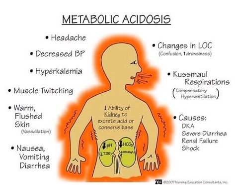 Metabolic acidosis - Nursing school flash card Metabolic Acidosis, Acid Base Balance, Nurse Manager, Nursing Mnemonics, Nursing School Survival, Respiratory Therapy, Nurse Rock, Nursing School Studying, Nursing School Tips