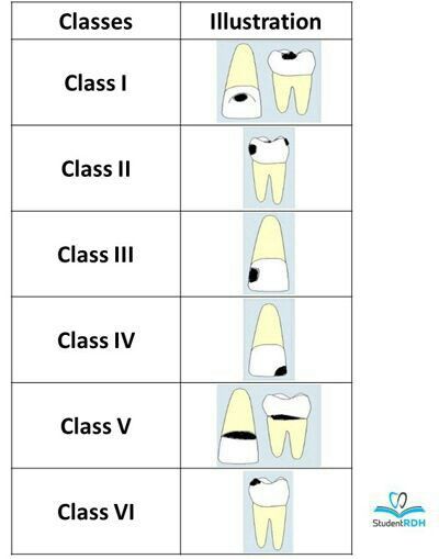 Gv Black Caries Classification, Dental Charting Symbols, Pediatric Dental Assistant, Dental Assistant Study Guide, Dental Charting, Dental Nursing, Registered Dental Assistant, Dental Assistant School, Dental Hygienist School