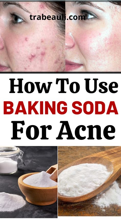 baking soda for acne Baking Soda Face Mask For Acne, Baking Soda Face Scrub Acne, Diy Zit Remover Overnight, Overnight Acne Remedies Fast, Baking Soda For Skin, Baking Soda For Acne, Baking Soda Coconut Oil, Baking Soda Face, Baking Soda Benefits