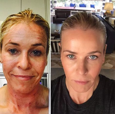 chelsea-handler-style Morpheus 8 Before And After Face, Morpheus8 Before And After, Face Fillers Before And After, Morpheus 8 Before And After, Filler Transformation, Profractional Laser, Morpheus 8, Laser Facial, Laser Resurfacing