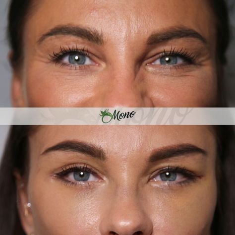 Cat Eyes, Fox Eyes, Eyebrow Lifting Cat Eye Surgery Before And After, Cat Eye Surgery, Reverse Cat Eye Hooded Eyes, Pixee Fox, Fox Eye Thread Lift Before And After, Fox Eye Lift Surgery, Eyebrow Lift, Fox Eyes, Eye Surgery