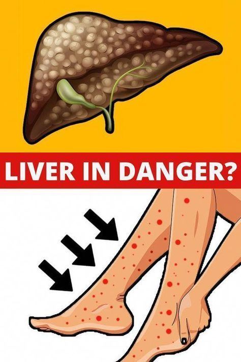 6 signs that your liver is tired and full of toxins Liver Cleanse Juice, Liver Issues, Kidney Detox, What Is Health, Body Muscles, Liver Diet, African Cooking, Liver Failure, Saving Plan