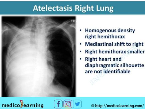 Chest X-ray interpretation Respiratory Therapy Notes, Chest X Ray, Medical Radiography, Medical Mnemonics, Radiology Imaging, Radiology Tech, Radiology Technologist, Medical Pictures, Cardiac Nursing