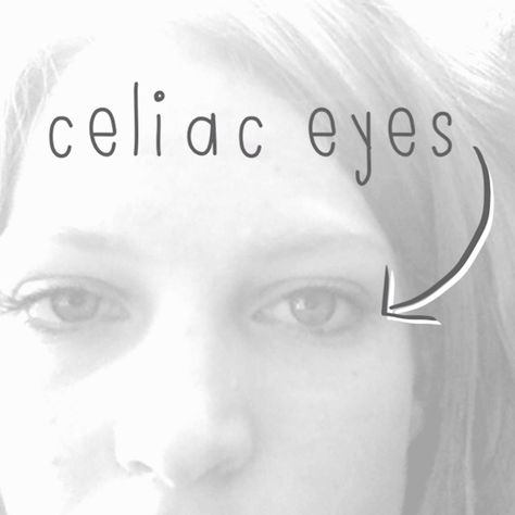 What I want you to know about celiac disease - inspiredrd.com Celiac Eyes, Celiac Awareness, Gluten Free Info, Coeliac Disease, Going Gluten Free, Gluten Free Living, Gluten Sensitivity, Diastasis Recti, Gluten Intolerance