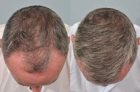 Is Hair Transplant Surgery Possible for Over 50s People? – Hair Transplant Place Hair Transplant Cost, Hair Transplant Results, Hair Transplant Procedure, Fue Hair Transplant, Hair Transplant Surgery, Best Hair Transplant, Male Pattern Baldness, Pattern Baldness, Lost Hair