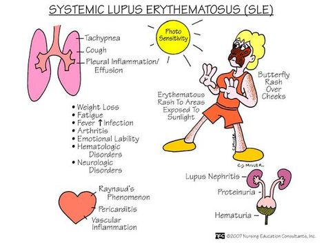 Nursing Mnemonics and Tips: Systemic Lupus Erythmatosus (SLE ... Lpn School, Med Surg Nursing, Nclex Prep, Nursing Mnemonics, Surgical Nursing, Medical Surgical Nursing, Pa School, Nursing School Survival, Nursing Life