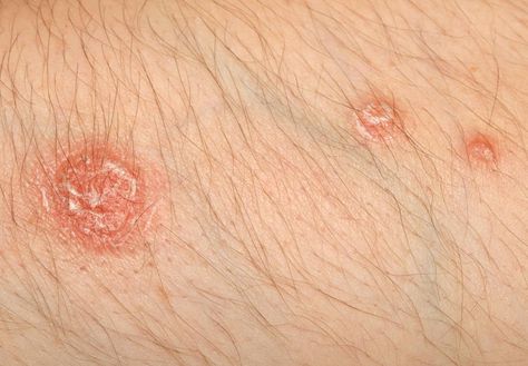 Psoriasis vs. pityriasis rosea: Symptoms and causes Psoriatic Skin, Anti Itch Cream, Scaly Skin, Skin Diseases, Red Light Therapy, Skin Discoloration, Skin Repair, Moisturizer For Dry Skin, Itchy Skin