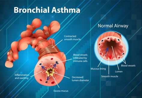 Asthma inflamed bronchial tube | Free Vector #Freepik #freevector #people #education #medical #cartoon Medical Cartoon, Infographic Education, Bronchial Asthma, Asthma Inhaler, Healthy Lungs, Chronic Obstructive Pulmonary Disease, Allergy Asthma, Asthma Symptoms, Pulmonary Disease