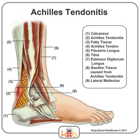 Achilles Tendonitis Causes Achilles Stretches, Achilles Tendinopathy, Ankle Pain Relief, Achilles Pain, Human Muscle Anatomy, Pain Relief Remedies, Achilles Tendon, Ankle Pain, Lower Back Pain Relief