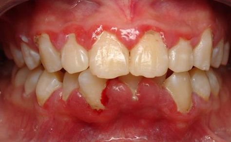 https://catxuonghammom.blogspot.com/2017/12/chua-rang-e-buot-tai-nha.html Inflammed Gums, Sore Gums Remedy, Swollen Gums Remedy, Swelling Remedies, Regain Confidence, Inflammation Remedies, Teeth Remedies, Gum Inflammation, Swollen Gum