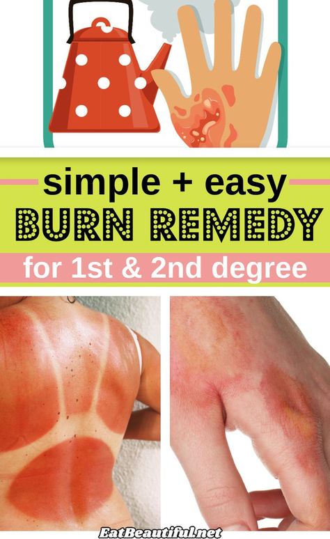 Learn the best home remedy for 1st and 2nd degree burns, including sunburns! — found in most home kitchens, and how and why to use it. 43% of all burns happen in the home... | Eat Beautiful | health | sunburn | remedy | how to | home | natural | burn | medicine | 1st degree | 2nd degree || #DIY #burn #remedy #natural #sunburn Sunburn Remedy, Home Remedies For Burns, 2nd Degree Burns, Home Remedies For Sunburn, Burn Remedy, Eat Beautiful, Severe Dry Skin, Sunburn Remedies, Organic Aloe Vera Gel