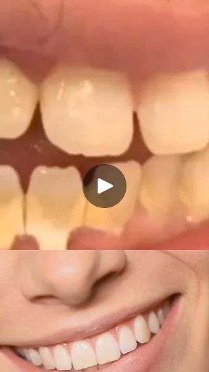 36K views · 713 reactions | Natural teeth whitening #healthyliving #teethwhitening #reels #explore #fyp
Whiten your yellow teeth instantly #remedy #Recipe #homeremedy #foodtiktok #whiteteeth #tooth
Here's how you can whiten your teeth quickly with this carrot recipe.#dent #dentsjaunes #tartre #dentssales #mauvaisehaleine
#commentblanchirlesdents | Natural Remedies.Recipes | Natural Remedies.Recipes · Original audio Yellow Teeth, Natural Teeth Whitening, Kid Experiments, Natural Teeth, Healthy Eating For Kids, Oral Health Care, Carrot Recipes, White Teeth, Tooth Decay