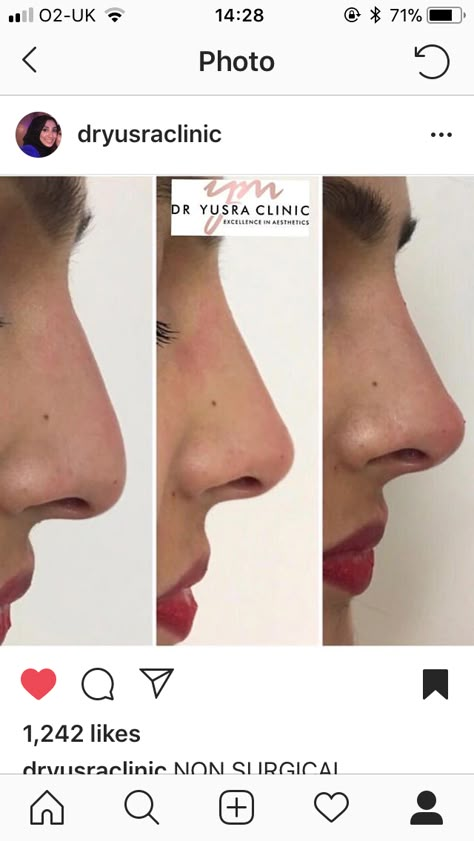 Non surgical Nose Plastic Surgery, Nonsurgical Nose Job, Nose Surgery Rhinoplasty, Nose Fillers, Rhinoplasty Nose Jobs, Nose Reshaping, Rhinoplasty Before And After, Face Surgery, Rhinoplasty Surgery