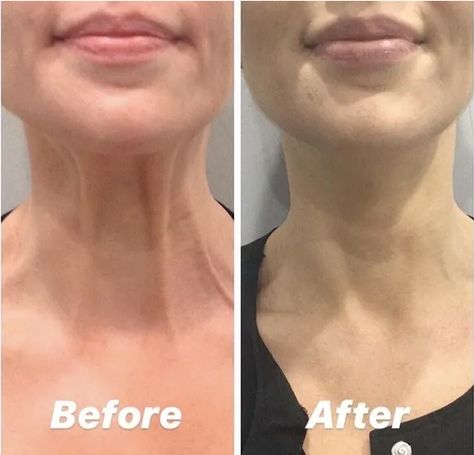 Neck Fillers Before And After, Wrinkles Before And After, Botox In Neck, Botox Neck Before After, Neck Botox Before And After, Neck Rejuvenation, Loose Neck Skin, Neck Tightening, Medi Spa