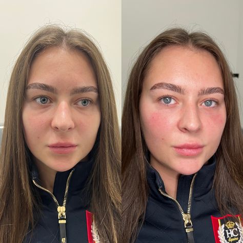 Tear Trough Filler before & afters 🪄 📍 84 Haverstock Hill, NW3 2BD 🏆 Award Winning Clinic 💰 £250 🔗 Link in bio to book ❤️ Tear Trough Filler Before After, Tear Trough Filler, Tear Trough, Award Winning, Link In Bio, Quick Saves