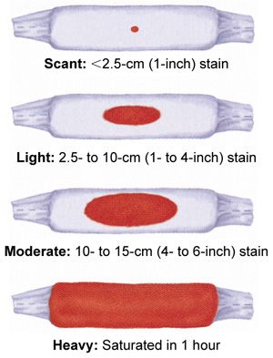 Lochia saturation levels: This is essential to monitor during the initial post-partum period. Remember: Excessive lochia can be a sign of hemorrhage! #Postpartum #OB #Nursing #NewMomma Obstetrics Nursing, Newborn Nursing, Postpartum Nursing, Child Nursing, Student Midwife, Nursing Mnemonics, Mother Baby Nurse, Ob Nursing, Neonatal Nurse