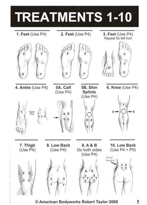 Tens Machine Placement, Tens Placement, Tens Electrode Placement, Facitis Plantar, Tens Unit Placement, Tens Therapy, Body Points, Tens Machine, Tens Unit