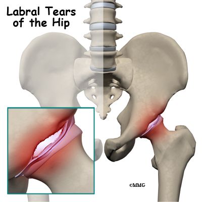 Acetabular labrum tears (labral tears) can cause pain, stiffness, and other disabling symptoms of the hip joint. Pain can occur if the labrum is damaged. Snapping Hip Syndrome, Torn Labrum, Fascia Lata, Hip Injuries, Hip Problems, Medical Procedures, Hip Surgery, Hip Dysplasia, Surgery Recovery