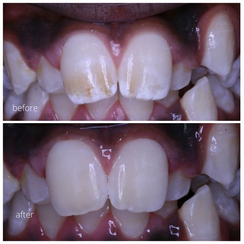 Before and after acid etch micro abrasion to remove Fluorosis on teeth. This procedure was completed in a 40 minute appointment at Leederville Dental , no local anaesthetic needed and only required 1 appointment. Dental Fluorosis, Diy Teething, Tooth Enamel, Dental Procedures