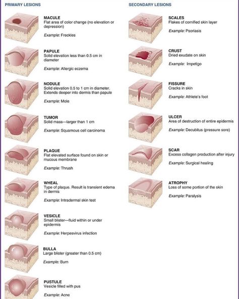 Medical Case Presentation 在 Instagram 上发布：“🔹️Different types of skin lesions . 🔸️Types of primary skin lesions  Birthmarks are primary skin lesions, as are moles, rashes, and acne.…” Cosmetology State Board Exam, Cosmetology State Board, Skin Lesions, Esthetician Inspiration, Nurse Study, Skin Anatomy, Medical Esthetician, Esthetician School, Case Presentation