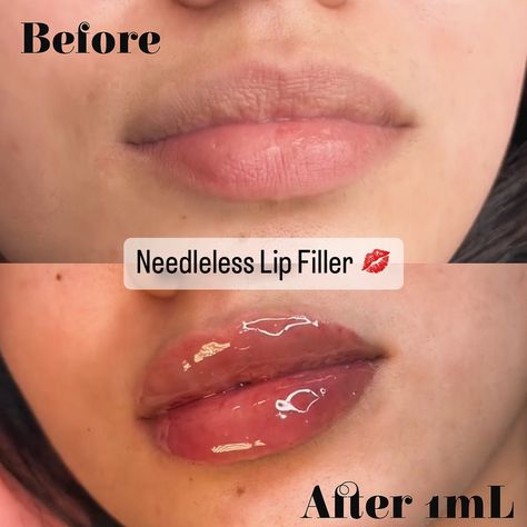 Want plump, juicy lips but are afraid of needles? 💉 Book a Needle-free Lip Filler service with me! 💋 ⚠️ Enjoy these special prices for a LIMITED time ⚠️ 💋 $175 for 1mL 💋 $225 for 1.5mL 💋 $275 for 2mL Before booking: 🚫 NO alcohol, caffeine, or smoking 48 hrs prior 🚫 NObody under 18 (I will check ID's) 🚫 NO existing medical conditions or medications **Travel available for additional fee (DM to discuss) Tap the Link in my Bio to book 🌷 ♛ 𝕽𝖆 𝕲𝖊𝖒𝖟 ♛ . . . #lipfiller #lipfillernyc #nyclipf... Small Lips Lip Filler, Doll Lips Filler, Lip Filler 2ml, Natural Lip Fillers 0.5ml, Lip Filler 1 Ml, .5ml Lip Filler, Lips Inspiration, Juicy Lips, Lip Fillers