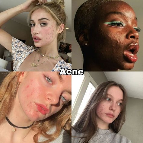 Beautiful insecurities pt.1✨ It's completely normal to have insecurities, but remember that true beauty comes from within. Focus on your positive qualities and embrace your unique features. Remember, you're amazing just the way you are! 😊🌟 Save for later📌 Like, share comment✨ Follow for more!> #acne#freckles#bigforehead#bignose#smalllips#thickeyebrows#teethgap Beautiful Insecurities Acne, Beautiful Insecurities Nose, Embracing Insecurities, Acne Is Beautiful, Normal Body Type, Beautiful Acne, Youre Amazing, Acne Journey, Acne Positivity