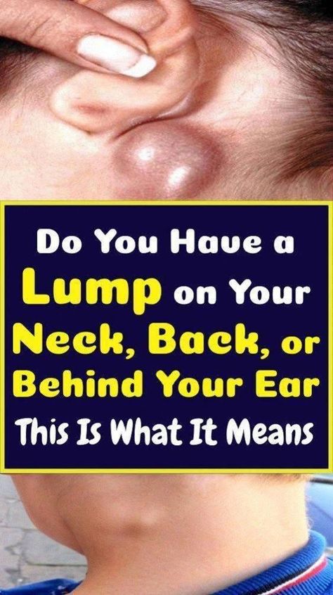 Do you have a lump in your neck, back, or behind your ear? Here’s what you need to know Lump Behind Ear, Skin Bumps, Health Signs, Women Health Care, Sleep Health, Liver Health, Healthy Lifestyle Tips, Health Articles, Healthcare System