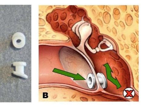 Guide: Not all kids need ear tubes to relieve fluid Fluid In Ears, Ear Tubes, Ear Picture, Ear Anatomy, Cartoon Ears, In Ears, Health Chart, Middle Ear, Ear Wax