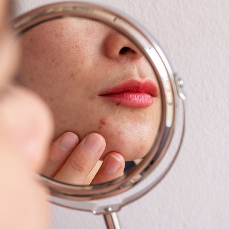 Find our which drugstore products are bad for your skin on SHEFinds.com. Skin Breaking Out, Tighten Facial Skin, Hormonal Acne, Get Rid Of Blackheads, Cystic Acne, Skin Allergies, How To Get Rid Of Acne, Acne Marks, Prevent Acne