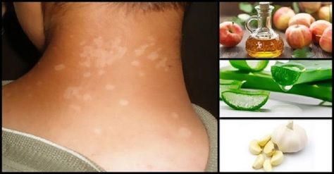 Tinea Versicolor is a common skin condition that causes patches of discolored, scaly skin. It’s caused by an overgrowth of yeast on the skin. Fortunately, there are several home remedies for Tinea Versicolor that can help reduce symptoms and improve the appearance of the skin. In this article, we’ll discuss 5 remedies for Tinea Versicolor that you can do at home. Yeast Infection On Skin, Tinea Versicolor, Garlic Supplements, Turmeric Juice, Oregano Essential Oil, Homeopathy Medicine, Natural Home Remedies, Natural Treatments, Health Diet