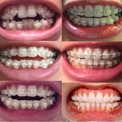 Clear Braces Aesthetic, Braces Progress, Porcelain Braces, Braces Aesthetic, Braces Journey, Adult Braces, Braces Tips, Clear Braces, Braces Colors