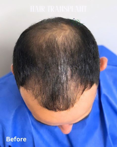 Get Your Hair Back at a Special Price! For a limited time only, take advantage of our exclusive hair transplant offer at Dr. Bijan's Clinic. Transform your look with expert care and at an unbeatable price. Don’t miss this chance to restore your confidence! **Book Now and Save!** 👇👇���👇 Free video consultation --- #HairTransplant #SpecialOffer #DrBijanClinic #HairRestoration #ConfidenceBoost #LimitedTimeOffer #Aesthetic#HairLossSolution #SydneyHairClinic #sydneyhairtransplant #brisbine #goldc... Hair Clinic, Hair Back, Hair Restoration, Hair Transplant, Confidence Boost, Free Videos, Special Price, Limited Time, Confidence