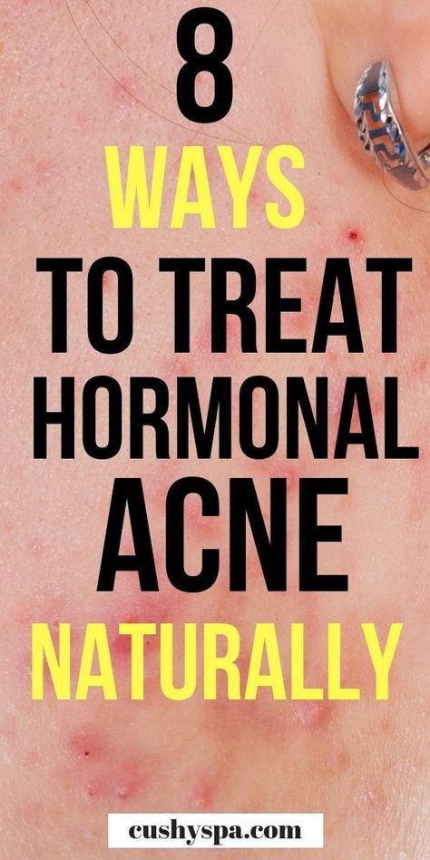 Treat Hormonal Acne, Acne Treatments, Natural Acne Remedies, Natural Acne, Severe Acne, Home Remedies For Acne, Hormonal Acne, Acne Breakout, Cystic Acne