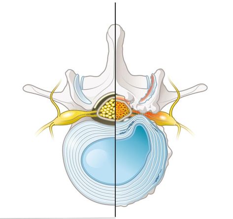 Spinal Canal Stenosis, Intervertebral Disc, Art Couple, Couple Art, Vector Art, Stock Illustration, Art